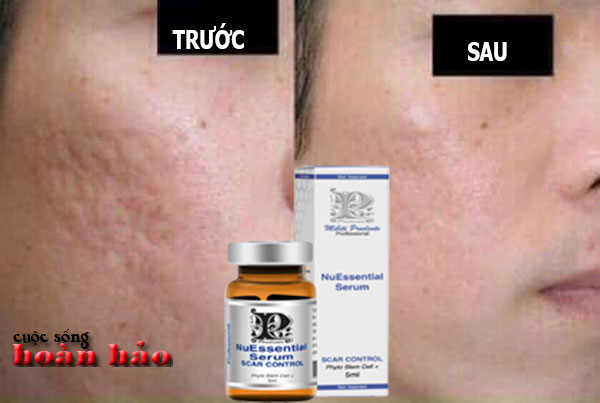 te-bao-goc-tri-seo-ro-seo-lom-nuessential-serum-scar-control8